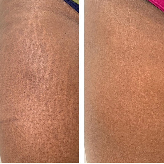 Fractional Scaring and Resurfacing