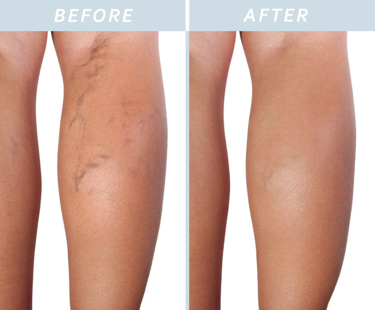 Long Pulse Vein Removal