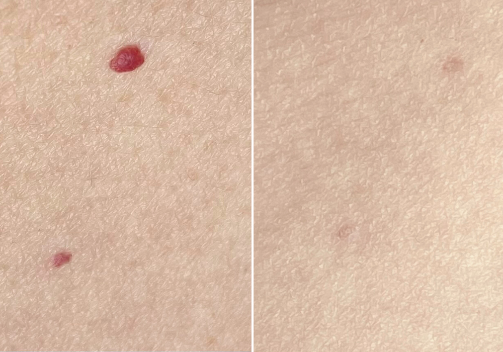 Cherry Hemangiomas