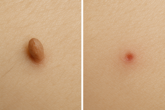 Skin Tag Removal