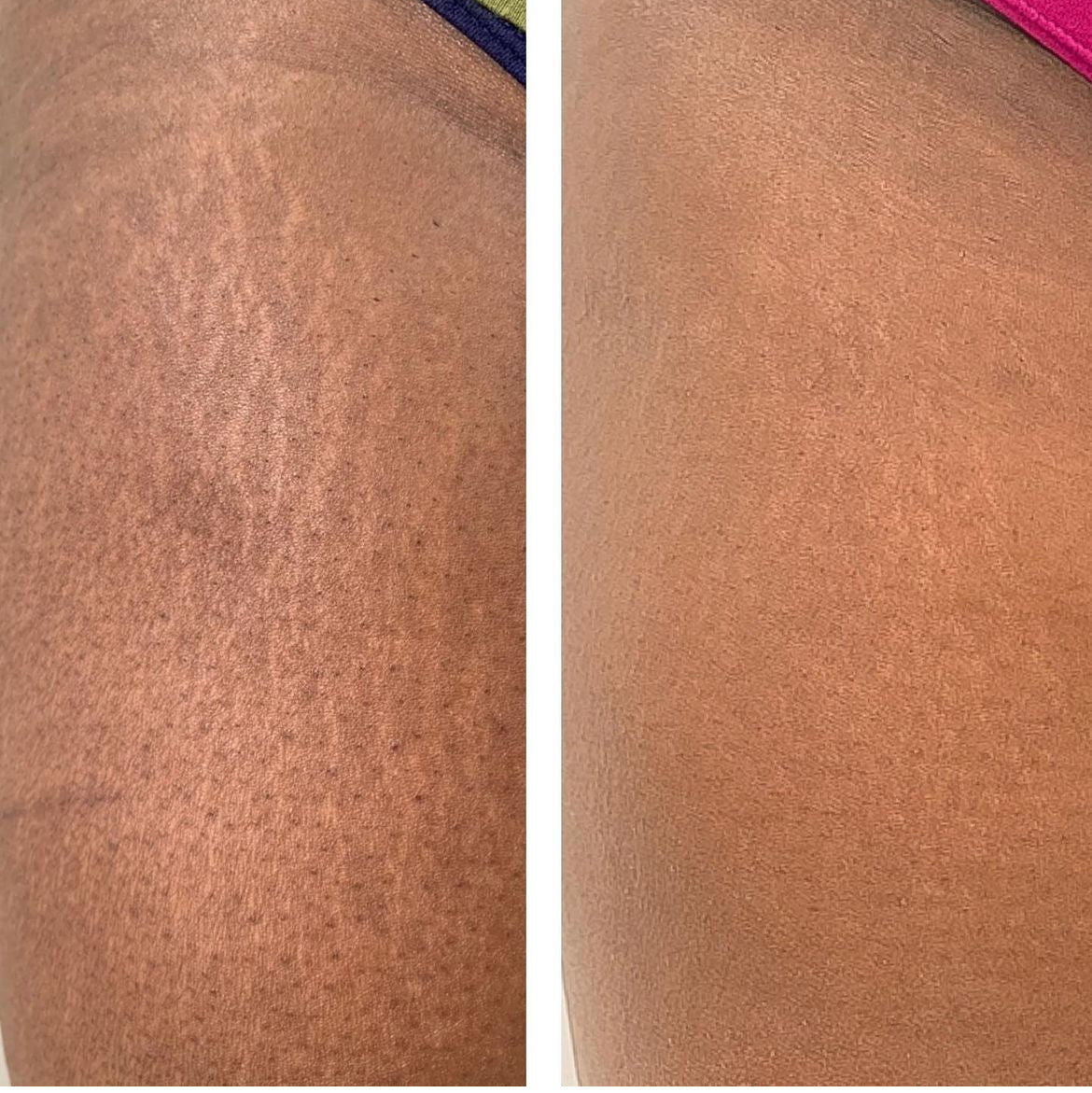 Fractional Scaring and Resurfacing