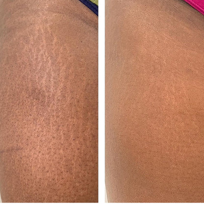 Fractional Scaring and Resurfacing