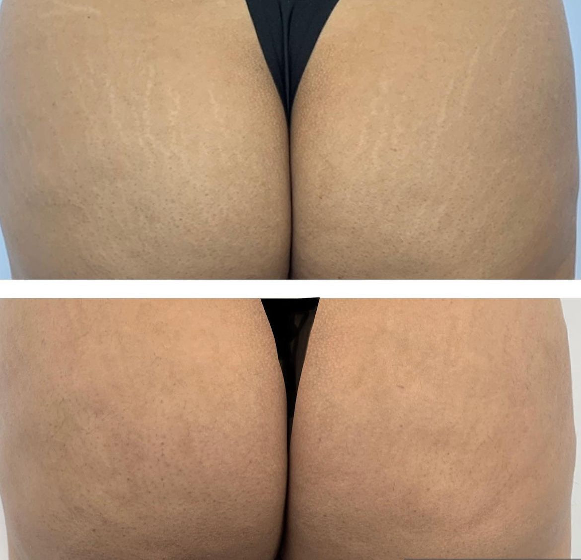 Fractional Scaring and Resurfacing