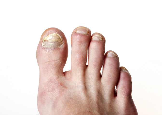 Toe Nail Fungus Removal