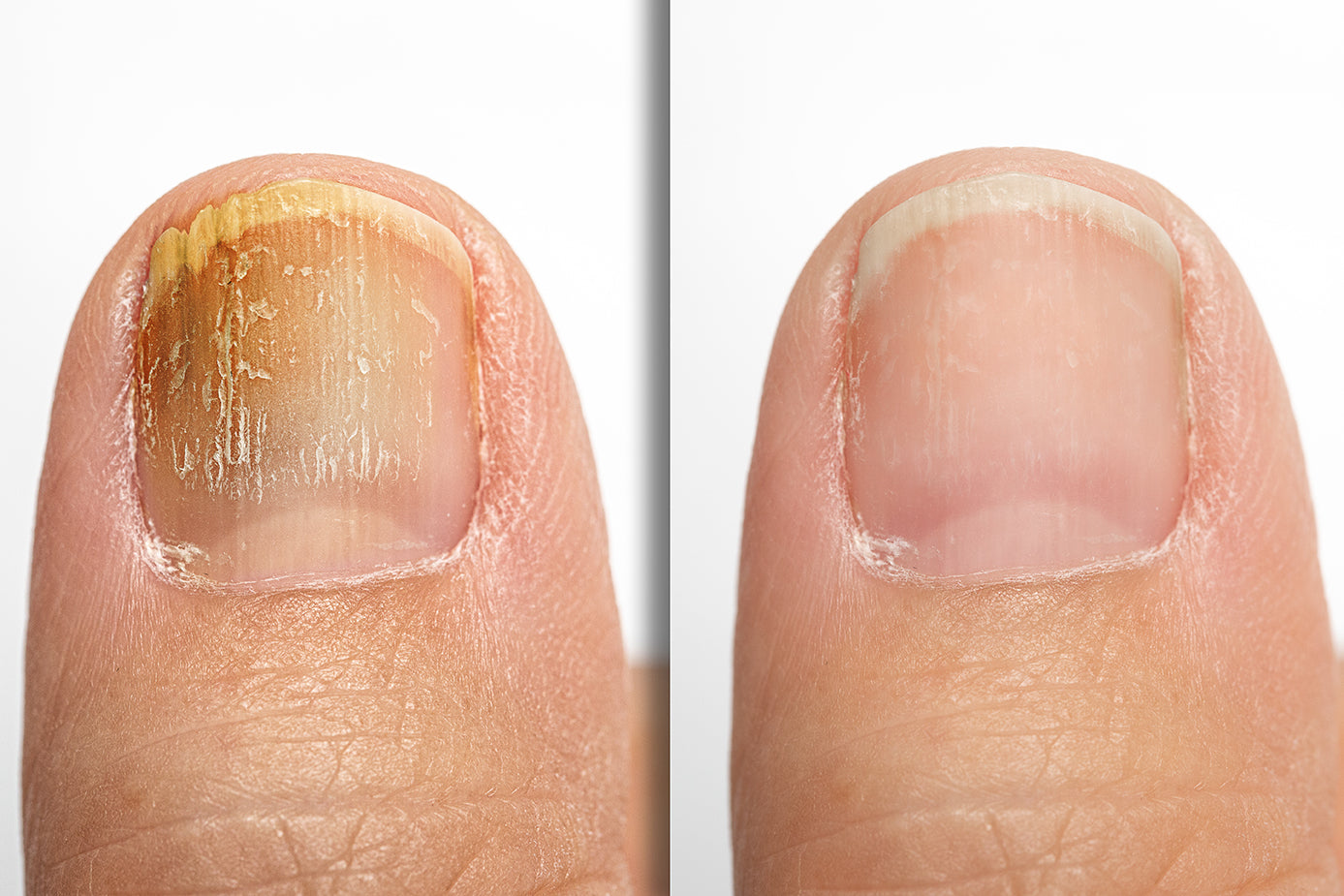Toe Nail Fungus Removal