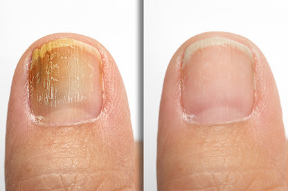 Toe Nail Fungus Removal