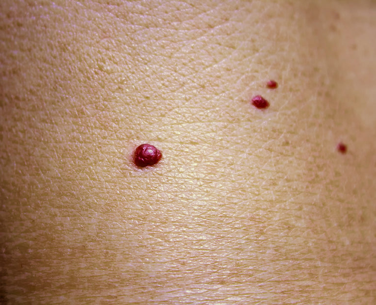 Cherry Hemangiomas