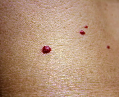 Cherry Hemangiomas