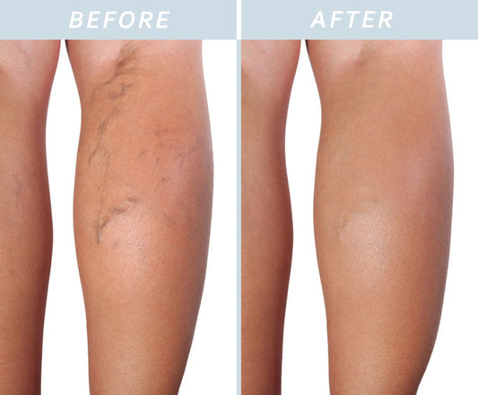 Long Pulse Vein Removal